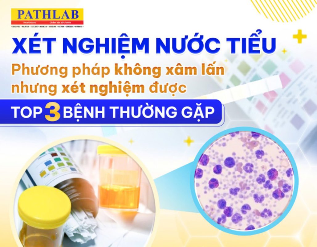 XET-NGHIEM-NUOC-TIEU-BAT-MI-03-CAN-BENH-THUONG-GA