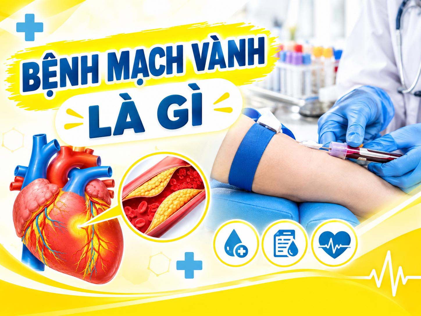 bệnh mạch vành