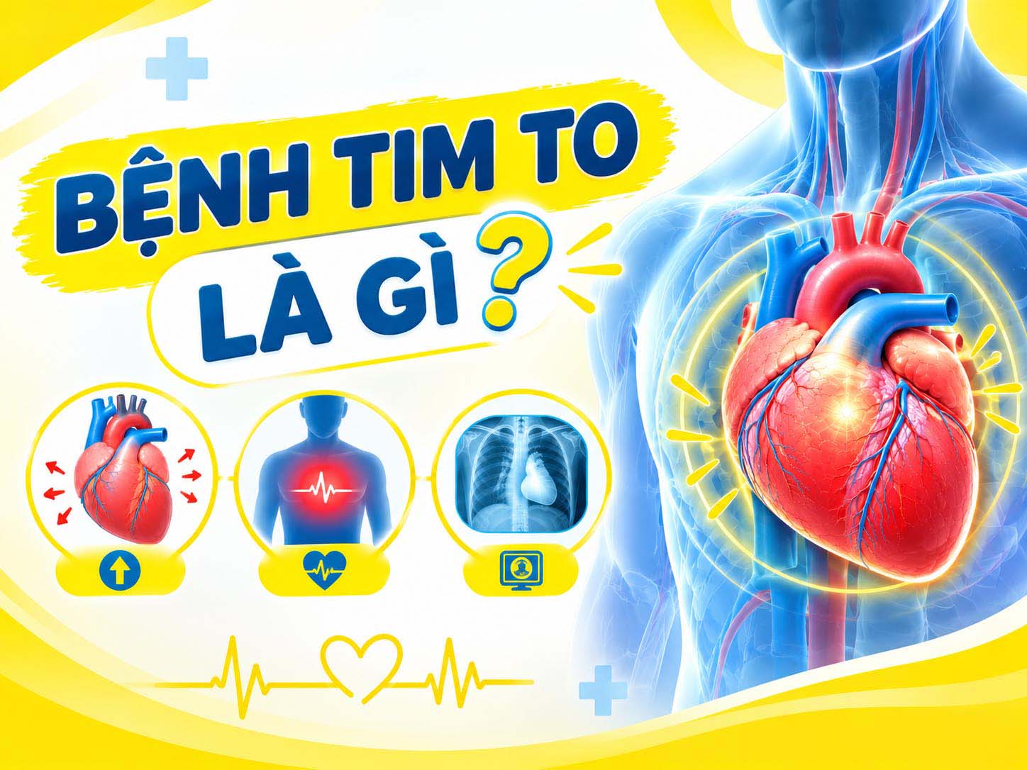 bệnh tim to
